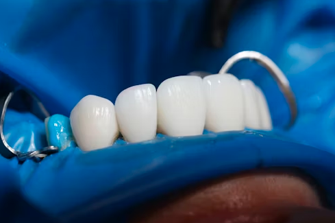 Dental Bridge in Lahore