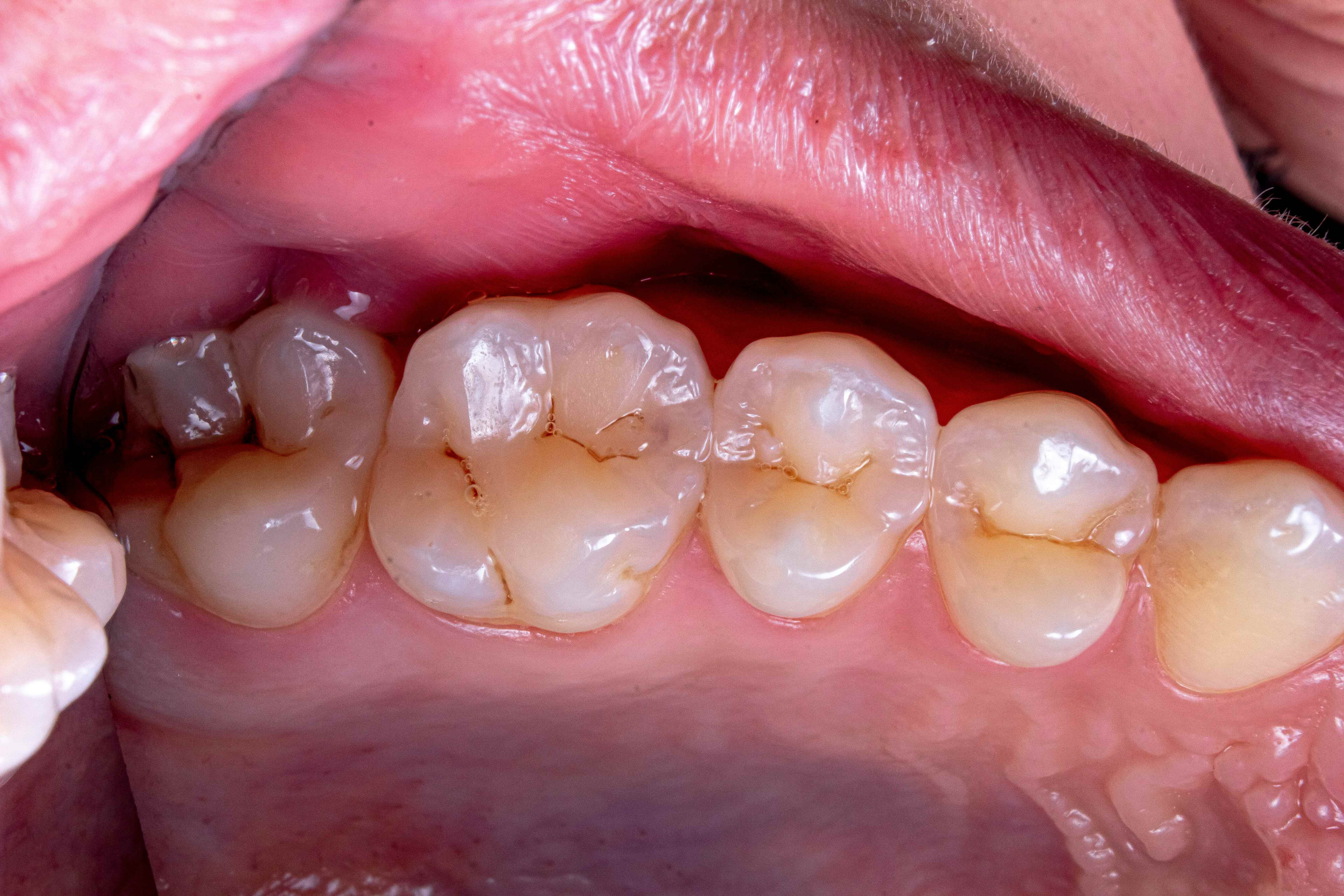 Composite Dental Fillings (Lahore)