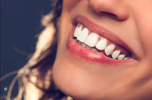 Dental veneers — Cosmetic Dentistry