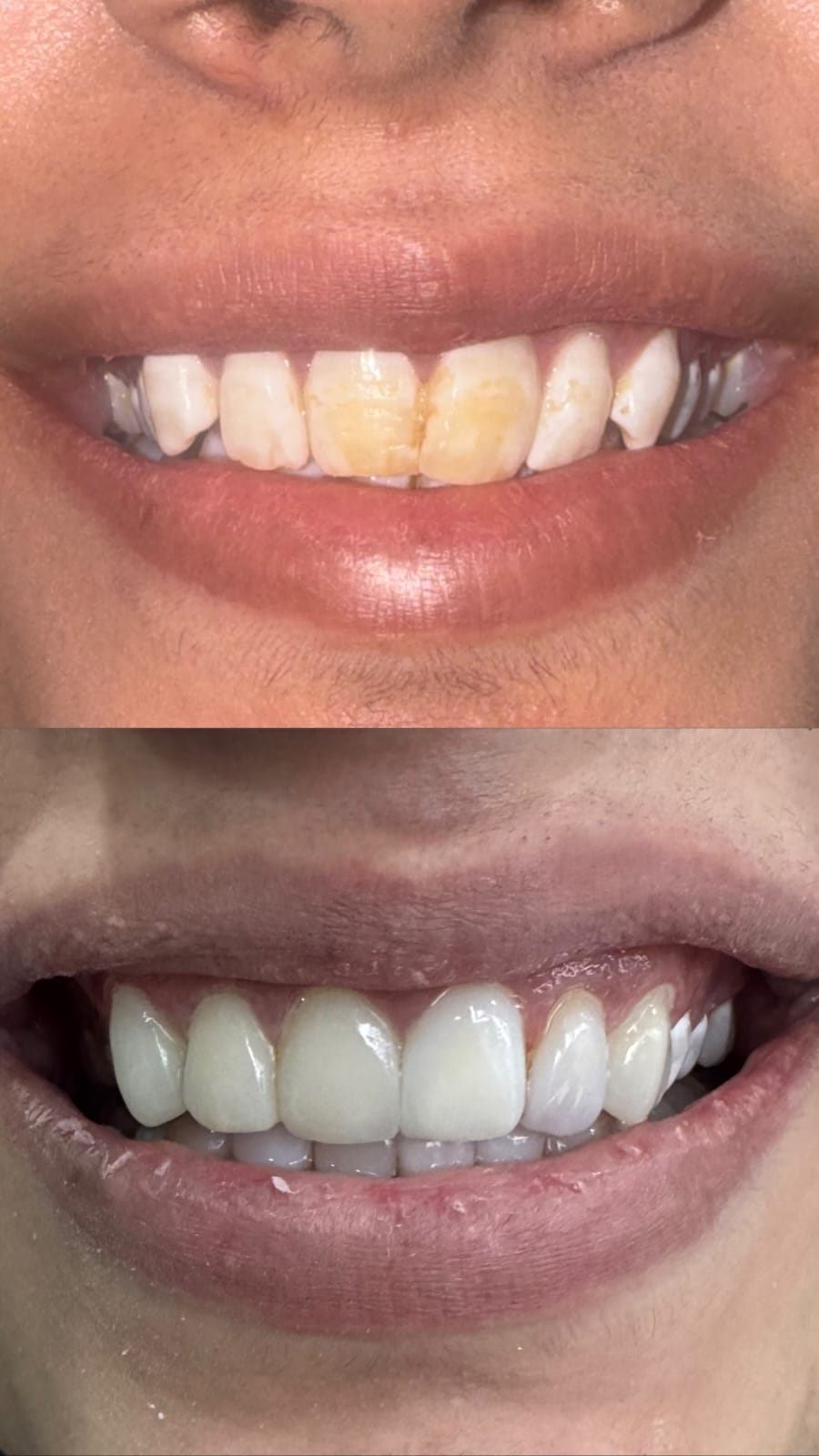 Veneers and Smile Makeover (Lahore)